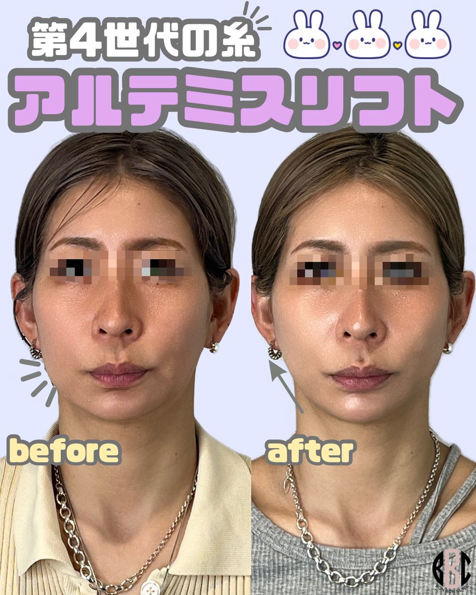 BONBONCLINIC's tweet photo. 予約殺到‼️大人気医師🧑🏻‍⚕️🌟
【池田先生症例】です🪄

BONBONCLINICでもついに‼️アルテミスリフトが導入されました✨✨

症例件数が豊富な医師による施術を是非受けてください⤴️🧚🏻‍♀️✨

ヒアル・ボトックス・カベリンも
お得なクーポン🎁LINE限定で配布中🌈

📲今すぐチェック💌

☎️03-6263-8261
LINE▶️【@bonbonclinic】で検索🔍

#銀座美容 #bonbonclinic #糸リフト #ヒアルロン酸 #ボトックス
