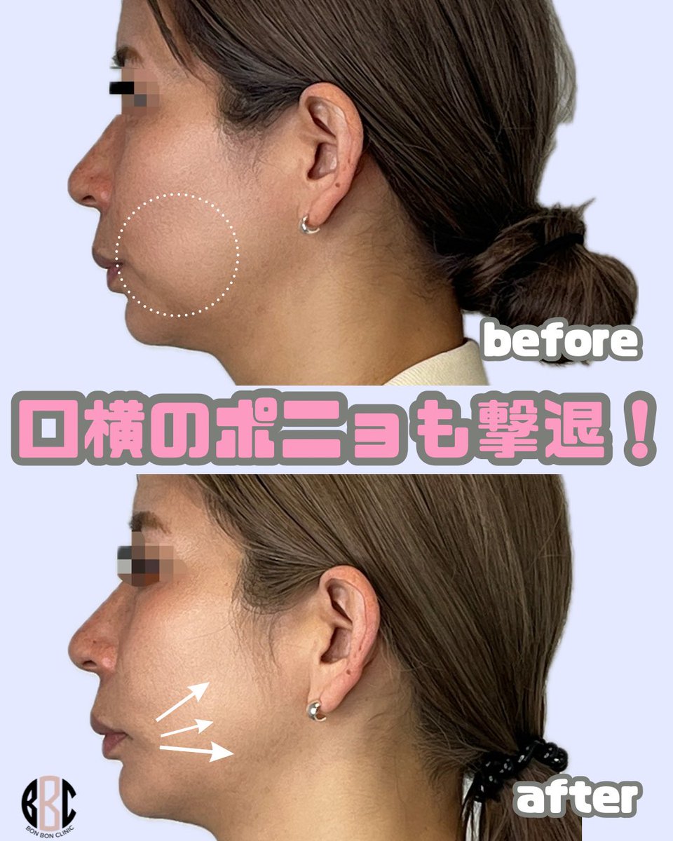 BONBONCLINIC's tweet photo. 予約殺到‼️大人気医師🧑🏻‍⚕️🌟
【池田先生症例】です🪄

BONBONCLINICでもついに‼️アルテミスリフトが導入されました✨✨

症例件数が豊富な医師による施術を是非受けてください⤴️🧚🏻‍♀️✨

ヒアル・ボトックス・カベリンも
お得なクーポン🎁LINE限定で配布中🌈

📲今すぐチェック💌

☎️03-6263-8261
LINE▶️【@bonbonclinic】で検索🔍

#銀座美容 #bonbonclinic #糸リフト #ヒアルロン酸 #ボトックス