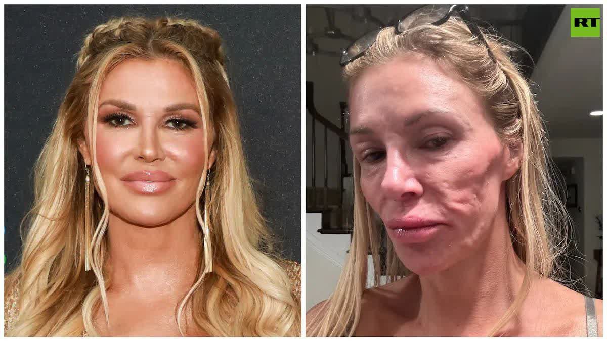 MichaelWhitake0's tweet photo. Reality Star finds MYSTERY FACE disfigurement caused by PARASITES

Real Housewives star Brandi Glanville stayed home for 3 YEARS until doctors found a parasitic ruptured breast implant 

She now raises awareness about silicone fragmentation illnesses

The Looker
@MichaelWhitake0 https://t.co/xxKtMyuL1g
