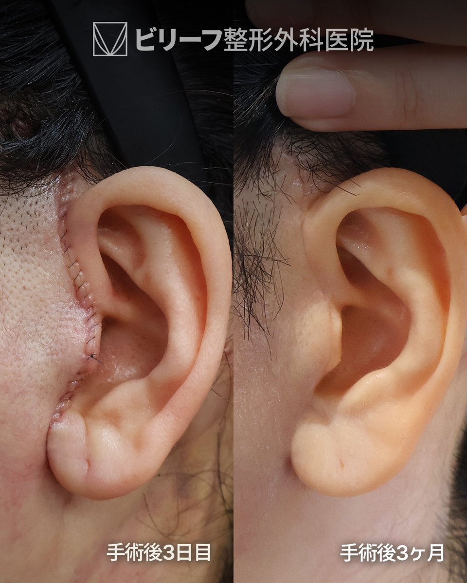 ✨韓国フェイスリフト専門ビリーフ美容外科✨ tweet media