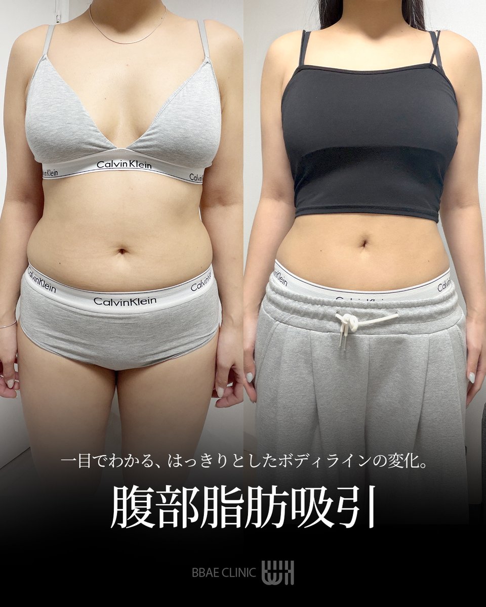 BBAE CLINIC | ポムナゲ・ペー ♥ 韓国脂肪吸引 tweet media