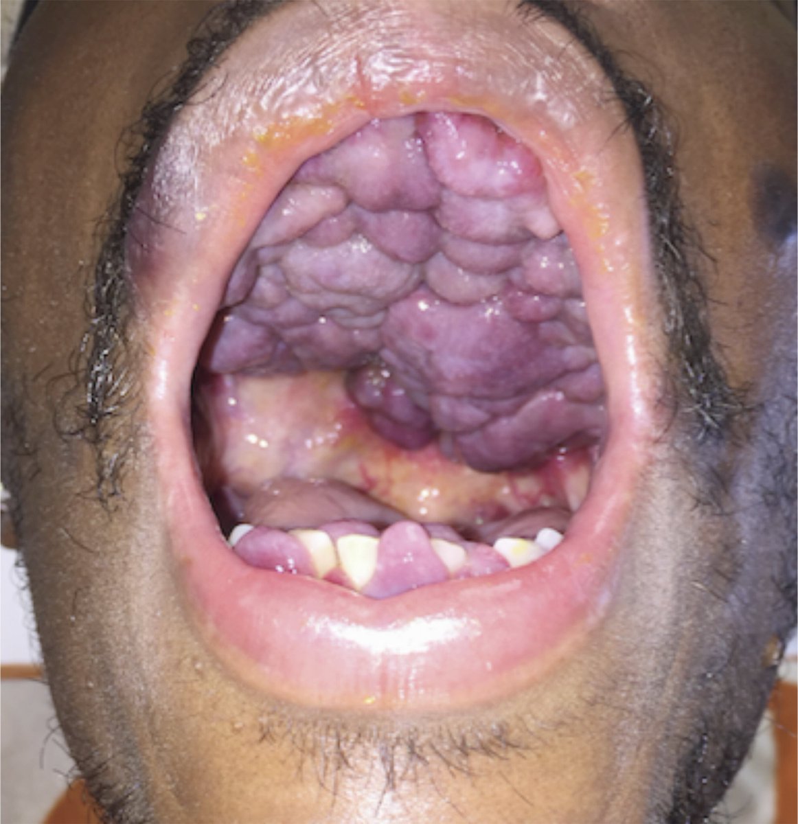 MTD_MED's tweet image. 33-year-old man 👇

• Fatigue &amp;amp; lesions in the oral cavity and on the skin
• Low CD4 count

What's the diagnosis?