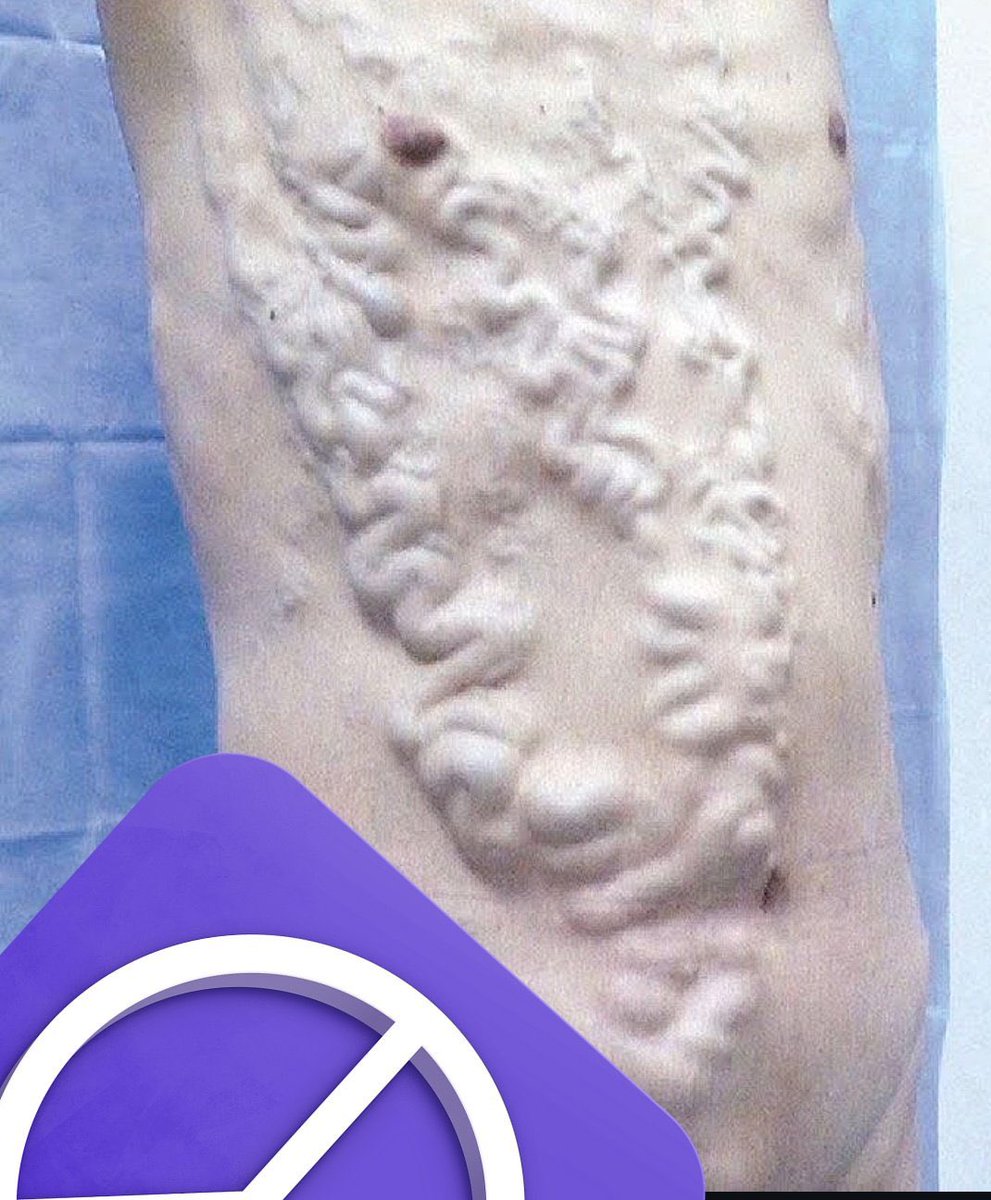 extensive-tortuous-dilated-superficial-veins-over-the-anterior