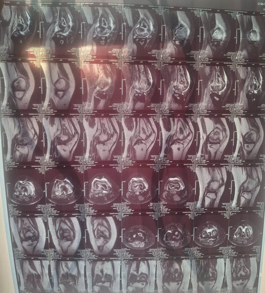 Қибрайлик Маъпура опанинг тизза соҳаси операция қилинганди.

Айни пайтда суяк тўлиқ битмаган.

Ҳозирда у яна даволаниши зарур.

Карта рақамлари:
8600 0610 7755 4755
5614 6816 2082 6382

Розиходжаева Мапура номида