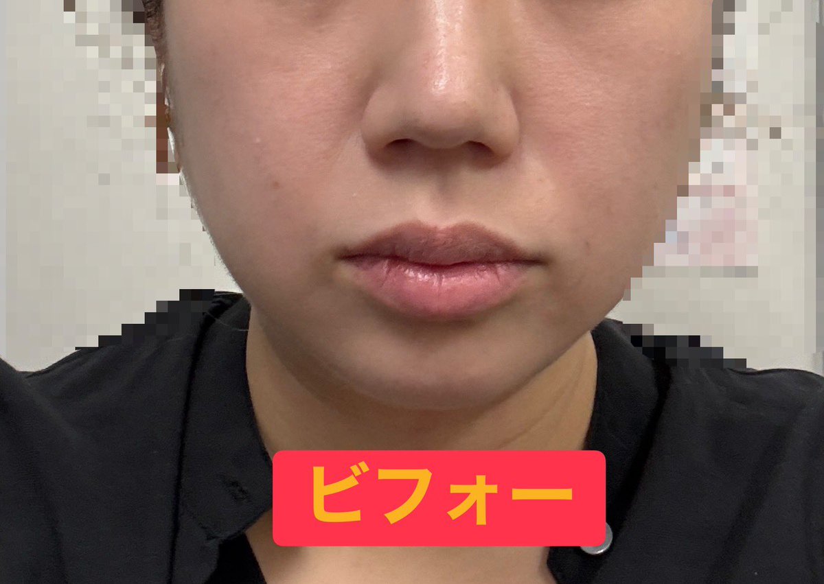 minnanohogosha's tweet photo. 東京シルククリニック　@tokyosilkclinic 

糸リフト、糸入れた段階でも鏡確認なく
糸入れ終わりでも鏡の確認なく
早々に退室を促されてあとから鏡見たらこの左右差なんですけど何の説明もないです

また、そちらの手違いについての謝罪もありませんでした。

これどういうことでしょうか？ https://t.co/ZZGkeKWAs3