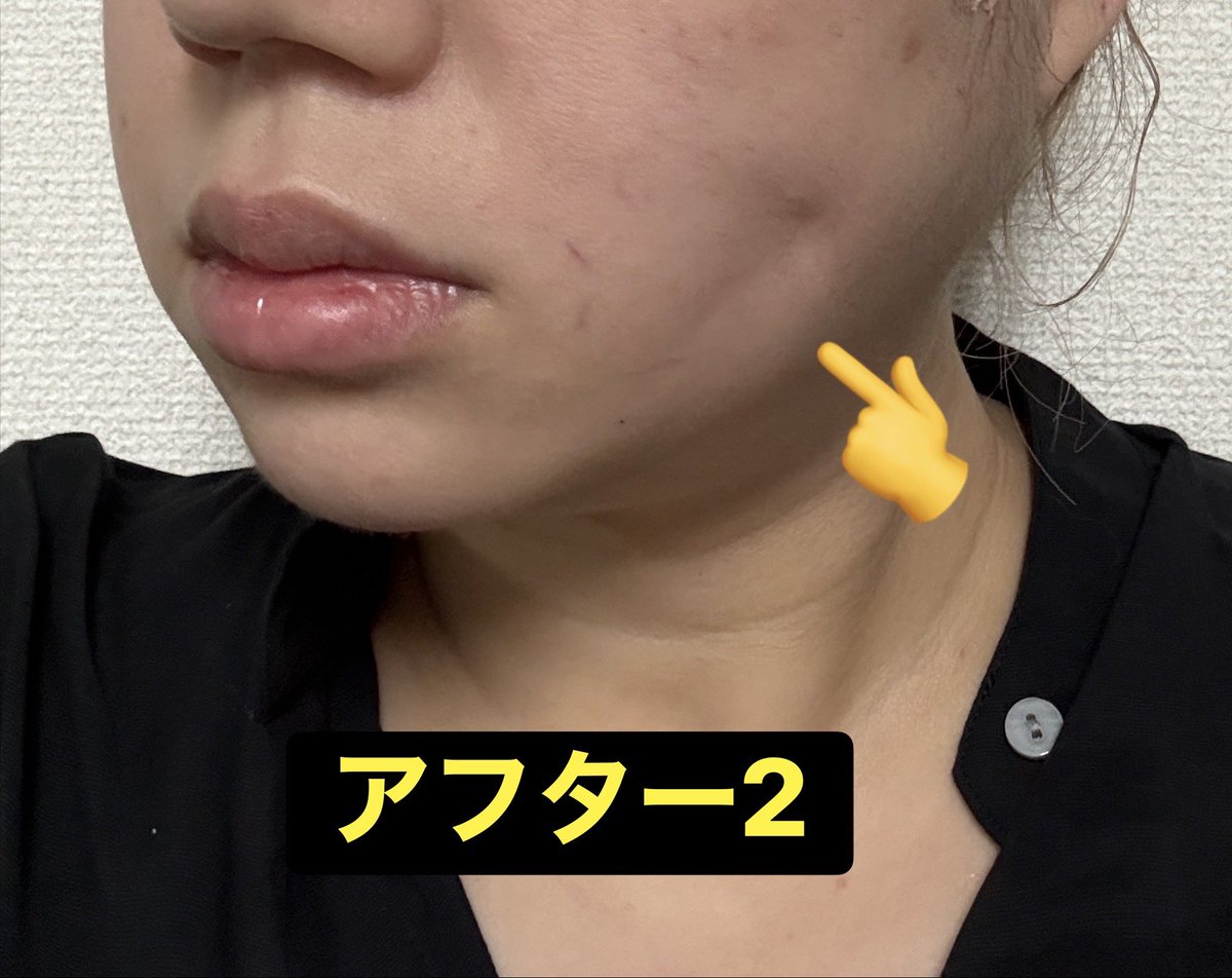 minnanohogosha's tweet photo. 東京シルククリニック　@tokyosilkclinic 

糸リフト、糸入れた段階でも鏡確認なく
糸入れ終わりでも鏡の確認なく
早々に退室を促されてあとから鏡見たらこの左右差なんですけど何の説明もないです

また、そちらの手違いについての謝罪もありませんでした。

これどういうことでしょうか？ https://t.co/ZZGkeKWAs3