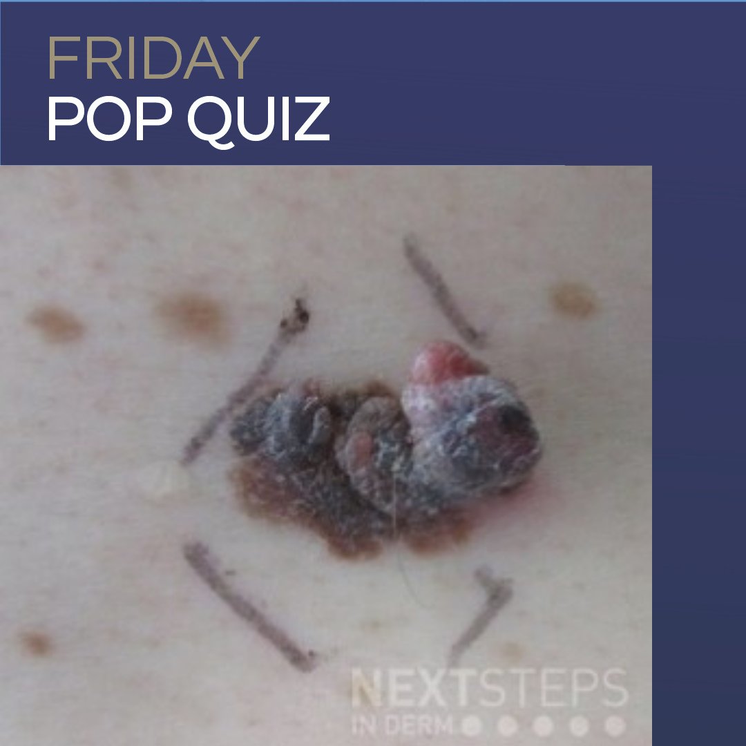 DermInReview's tweet photo. It’s Friday Pop Quiz time! 🧠✨ 

Think you can ace this week’s board review question? 

Drop your guess in the replies, then head to Next Steps in Derm to see if you’re right! Full explanations included: https://t.co/EprX3C42Ol https://t.co/pYO0y5N6Qs