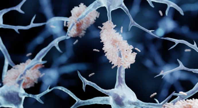 GacetaMedicaCom's tweet image. 🧠Nuevo avance contra el #Alzheimer: cómo los astrocitos modificados eliminan el amiloide en modelos animales

Investigadores de @WashU desarrollan una inmunoterapia de inyección única que reduce a la mitad las placas de amiloide en el #cerebro

gacetamedica.com/investigacion/…