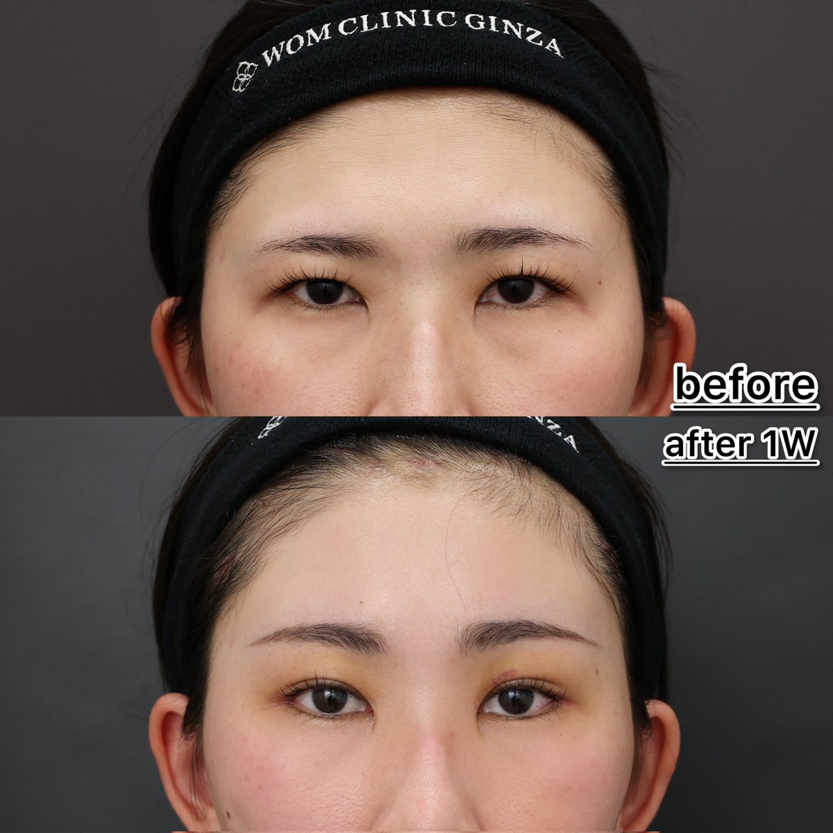 こだわリスト髙田【額挙上/目元整形/修正手術】｜髙田怜 tweet media