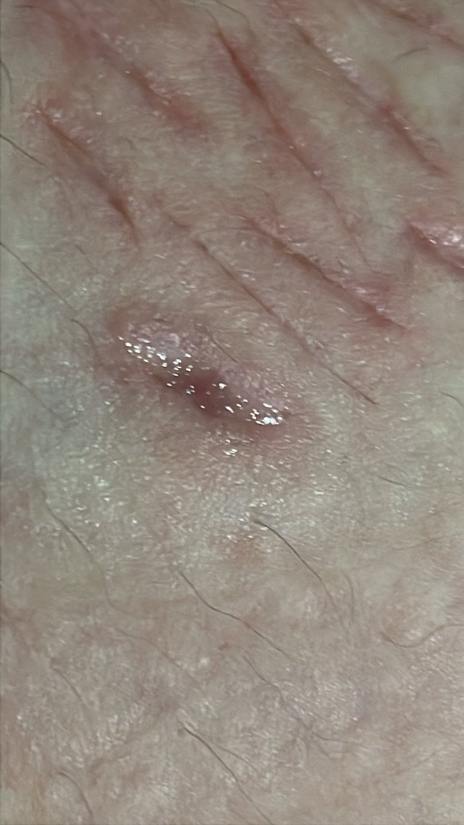 yutal1r's tweet image. Hi #shtwt #shedtwt 

These were baby beans and this is the third day of healing and im very scared of infection since it’s my first time hitting (somewhat) beans…. 
So does this look ok ?