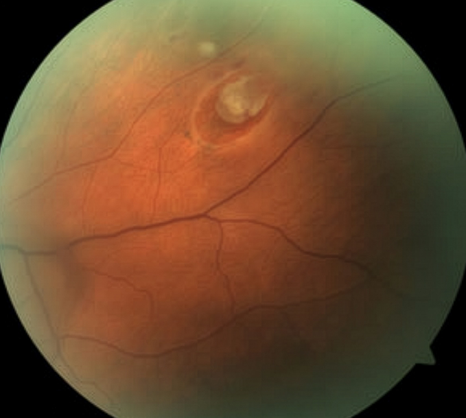 revoptom's tweet image. Study Reveals New Safety Signals of Oxymetazoline Eye Drops for Blepharoptosis

An evaluation of data highlighted novel associations with ocular complications, while also confirming on-label ocular effects.

reviewofoptometry.com/article/study-…

#optometry #eyecare #ptosis #eyedrop