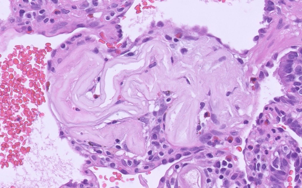 PeterKobalka's tweet image. An impressive example of this pathological process. What’s going on here? #pulmonarypath #thoracicpath #pathx #pathtwitter
