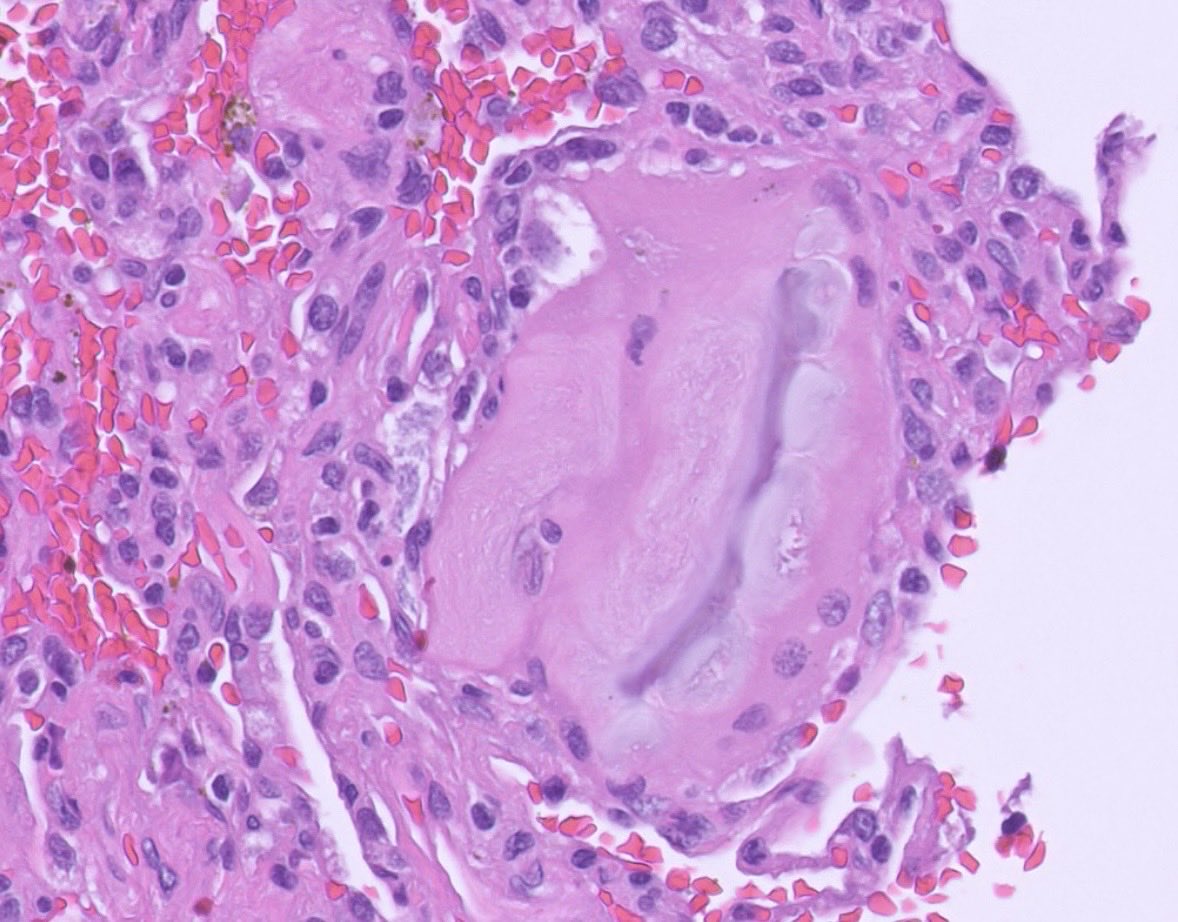 PeterKobalka's tweet image. An impressive example of this pathological process. What’s going on here? #pulmonarypath #thoracicpath #pathx #pathtwitter
