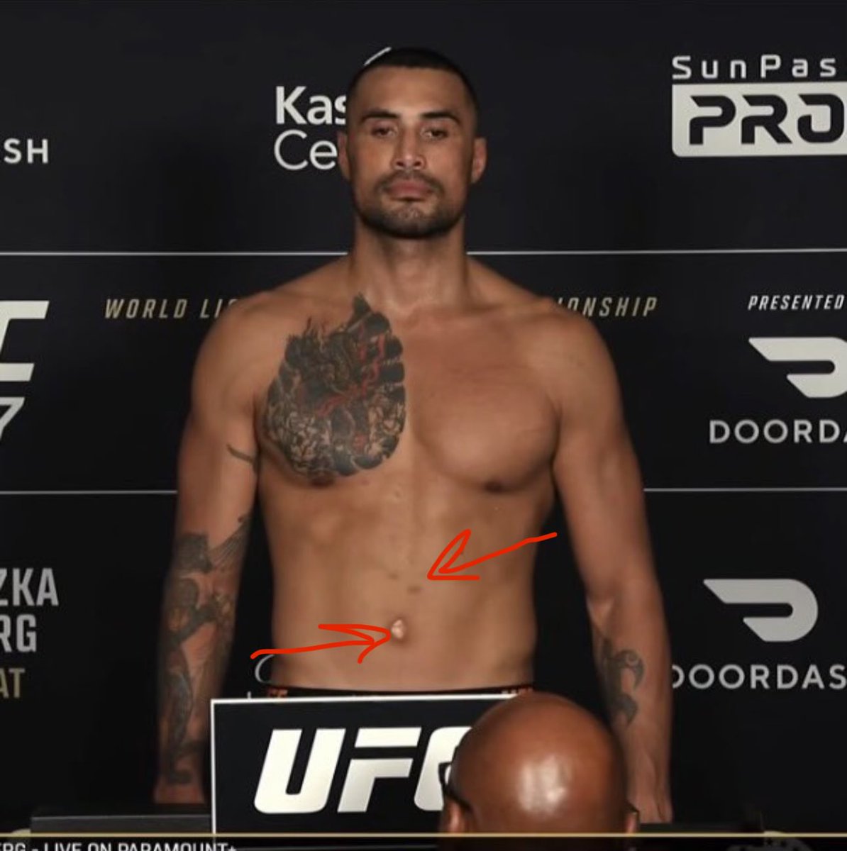 UFCaddict11's tweet photo. @JT_Lines Staph? https://t.co/PgFv6JKUOc