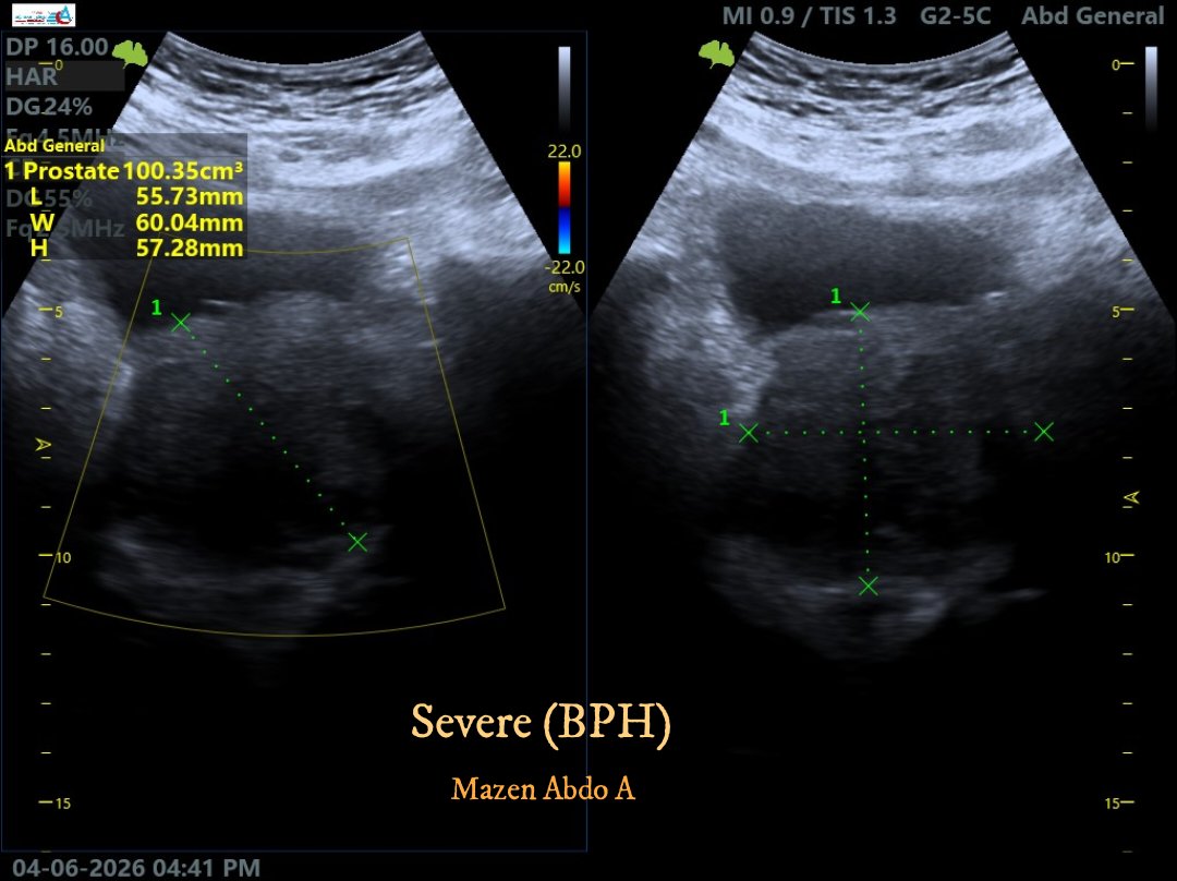 mznljrdy47597's tweet image. Ultrasound cases from my routine daily
practice. Severe (BPH)
#Ultrasound #BPH #ProstateHealth #Radiology #MedicalImaging #Healthcare #Urology #Sonography