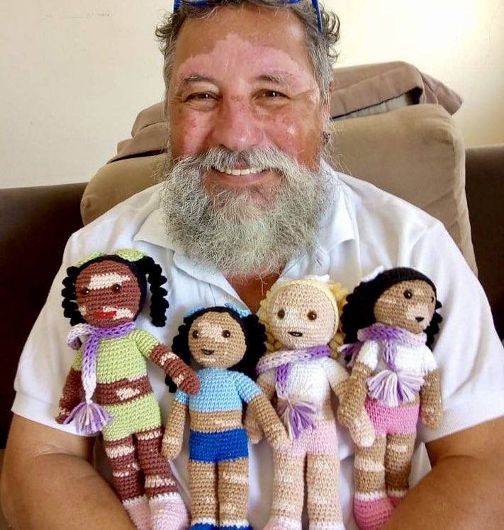 A Brazilian grandfather with vitiligo crocheted a doll that looked exactly like him for his granddaughter.

João Stanganelli Junior from Brazil took up the hobby after heart problems slowed him down from his old job. He carefully added the same white skin patches he has lived