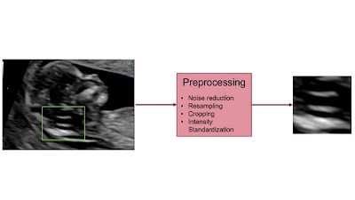 Radiology_AI's tweet image. AIRFRAME part 1: developing a deep-learning algorithm for identifying posterior fossa abnormalities on first-trimester US screen scans doi.org/10.1148/ryai.2…  @VagniMarica #DeepLearning #ultrasound #PedsRad