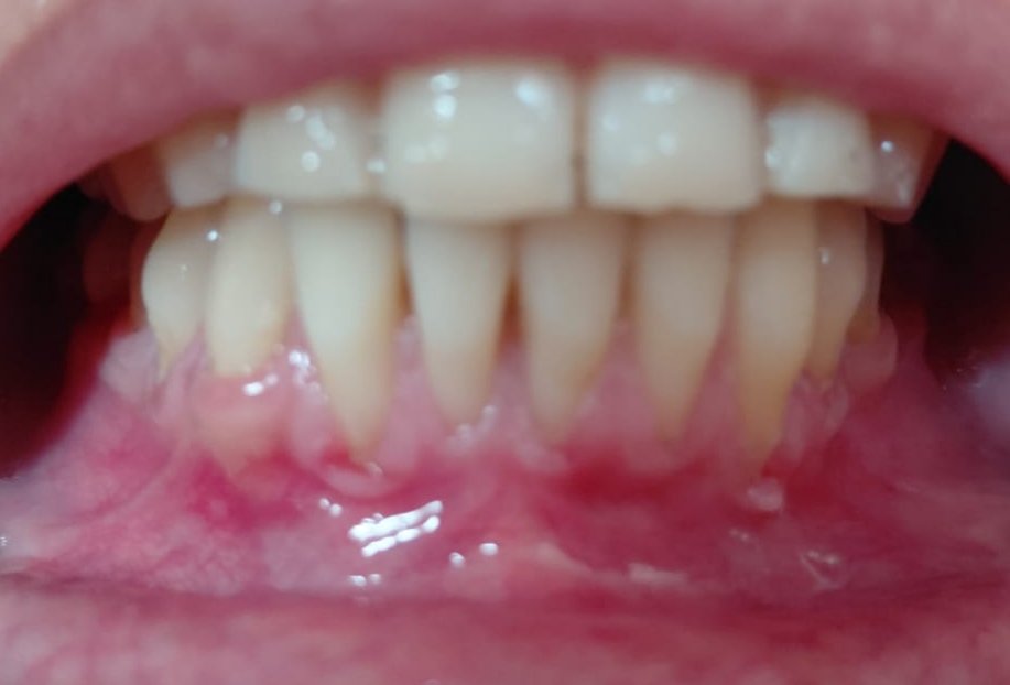 My sister is facing a heartbreaking health crisis. She has been diagnosed with severe gum recession and bone loss. Doctors say she needs urgent surgery costing $2,000 to save her teeth before it’s too late. Every little bit helps her. 
chuffed.org/project/help-a…
