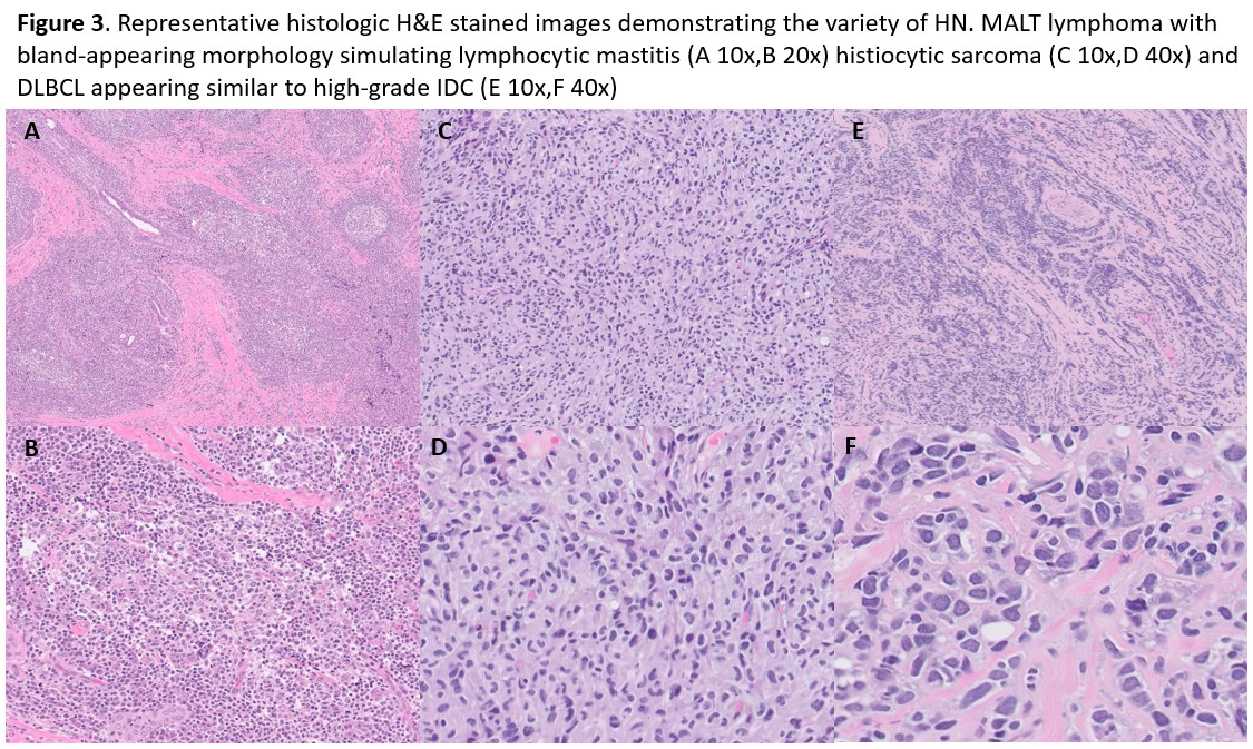 VickeryJasmine's tweet image. From USCAP poster to final publication! Now available in Annals of Hematology, Hematolymphoid neoplasms involving the breast :) #breastpath #pathtwitter #pathx #hemepath @SpringerNature 

rdcu.be/fcFy7