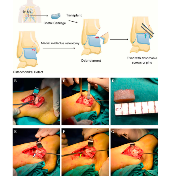 jbjs's tweet image. "Autologous Costal Cartilage Transplantation for Medial Osteochondral Lesions of the Talus" by Du et al.

Click the🔗 to read the full article 👉 bit.ly/4sp8S2t

#JBJS #OpenAccess