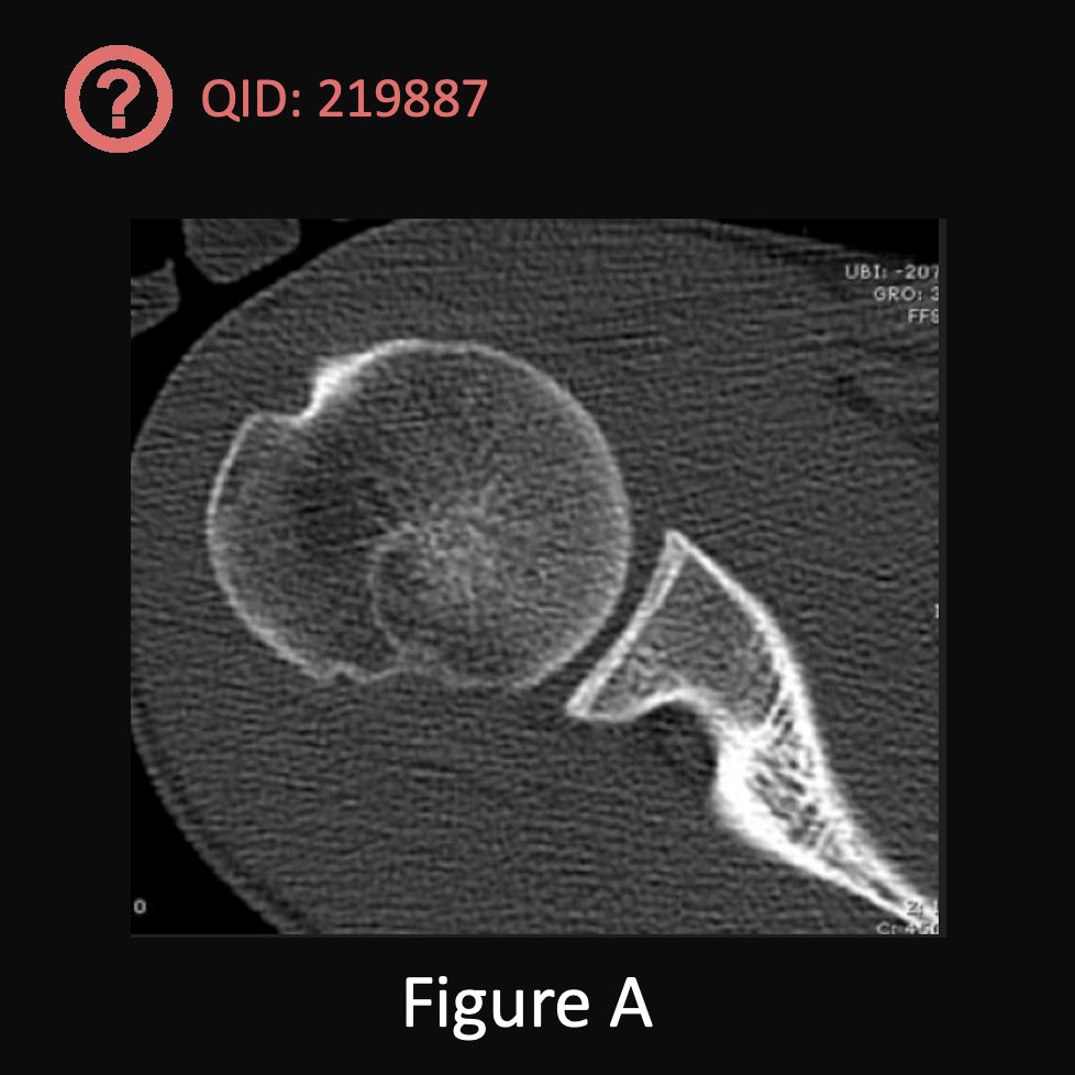 orthobullets's tweet image. Can you answer our free question of the day?

A 23-year-old man falls off a scaffold 15 feet high and sustains a right glenohumeral dislocation, which is promptly reduced in the emergency department. He is discharged, and subsequently sustains another dislocation which he