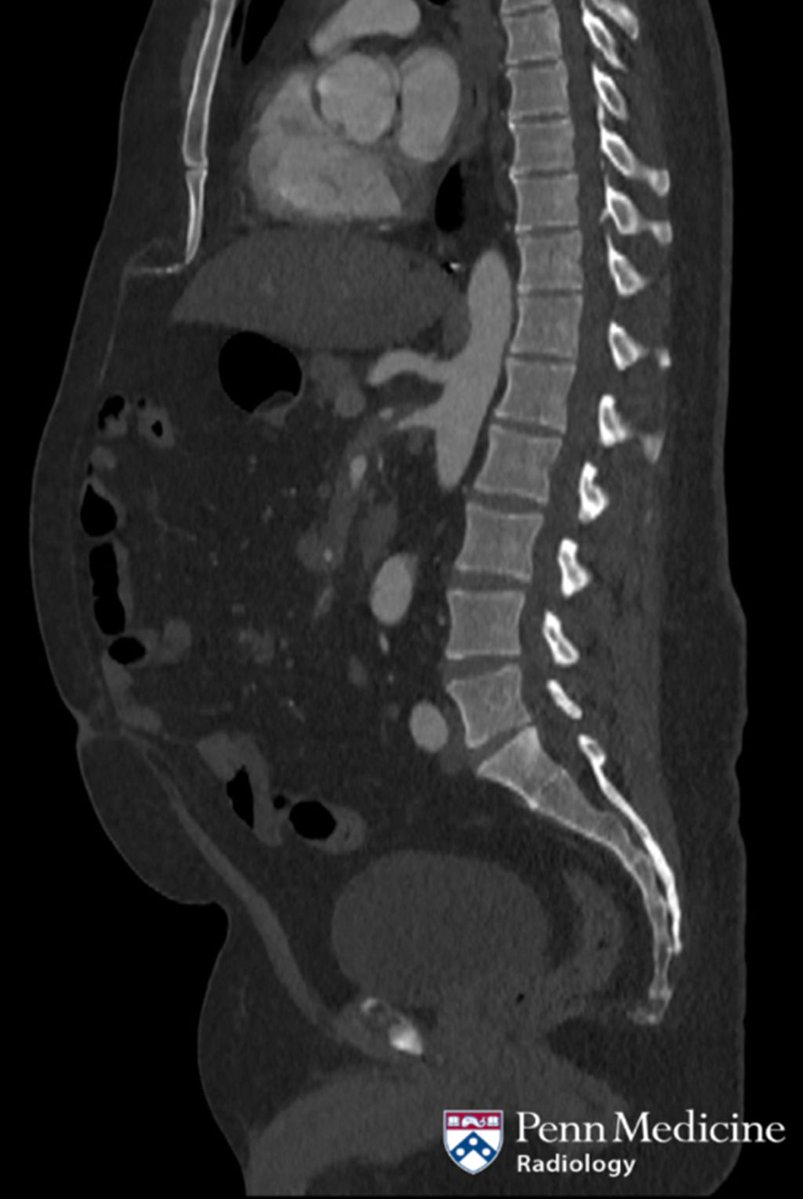 AuntMinnie's tweet image. Another case for your consideration! 48-year-old man with abdominal pain #radiology buff.ly/H8fUUp3
