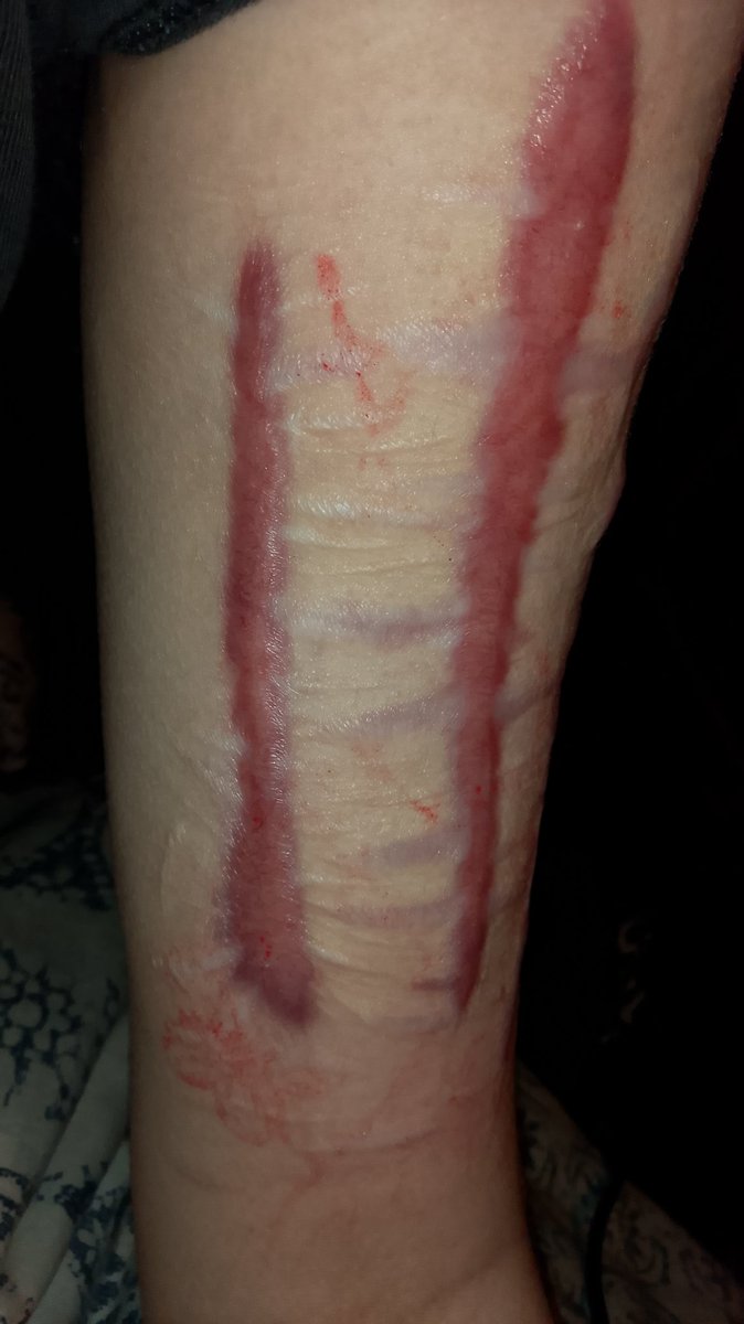 S0FI35SSs's tweet photo. These mothers fuckers hurt today 
#shedtwt #shtwt #scarspo https://t.co/OesqdKXU0u