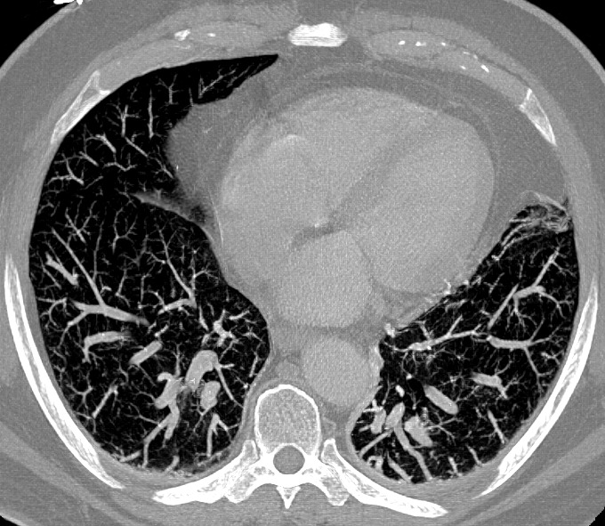 draceciferrario's tweet image. Can you spot what’s abnormal in the lung bases?
The abdominal findings hold the key…What are we seeing? 🧐

#radiology #medicine