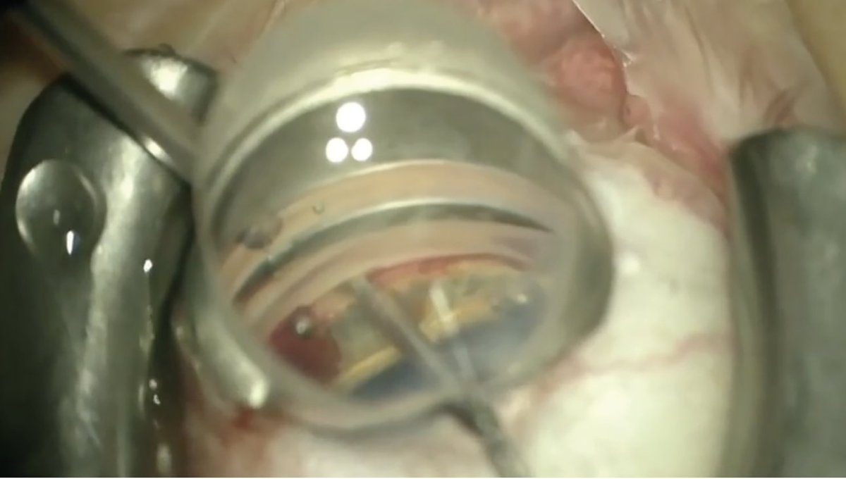 RevOphth's tweet image. MIGS &amp;amp; Mingle: Combining with Cataract Surgery

Comprehensive ophthalmologists have an opportunity to impact the burden of #glaucoma care by integrating minimally invasive glaucoma surgery. Here’s a look at the essential steps for success: reviewofophthalmology.com/article/migs-a…
#cataractsurgery