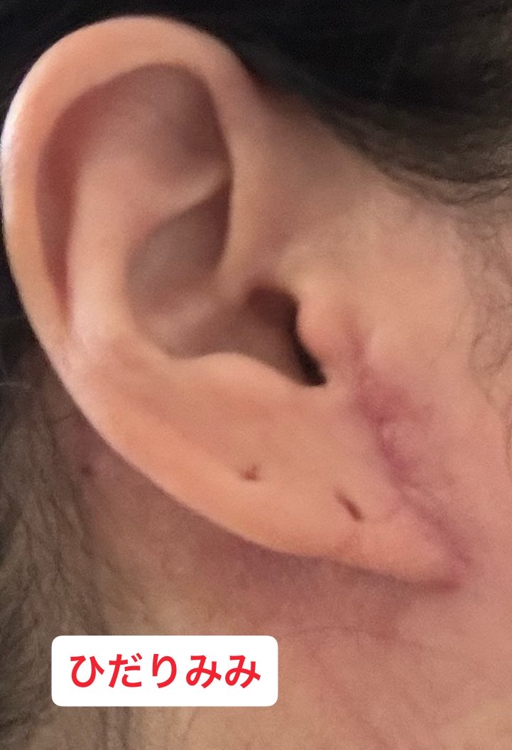 セサミ@切開フェイスリフトDT中（マンジャロ12.2〜） tweet media