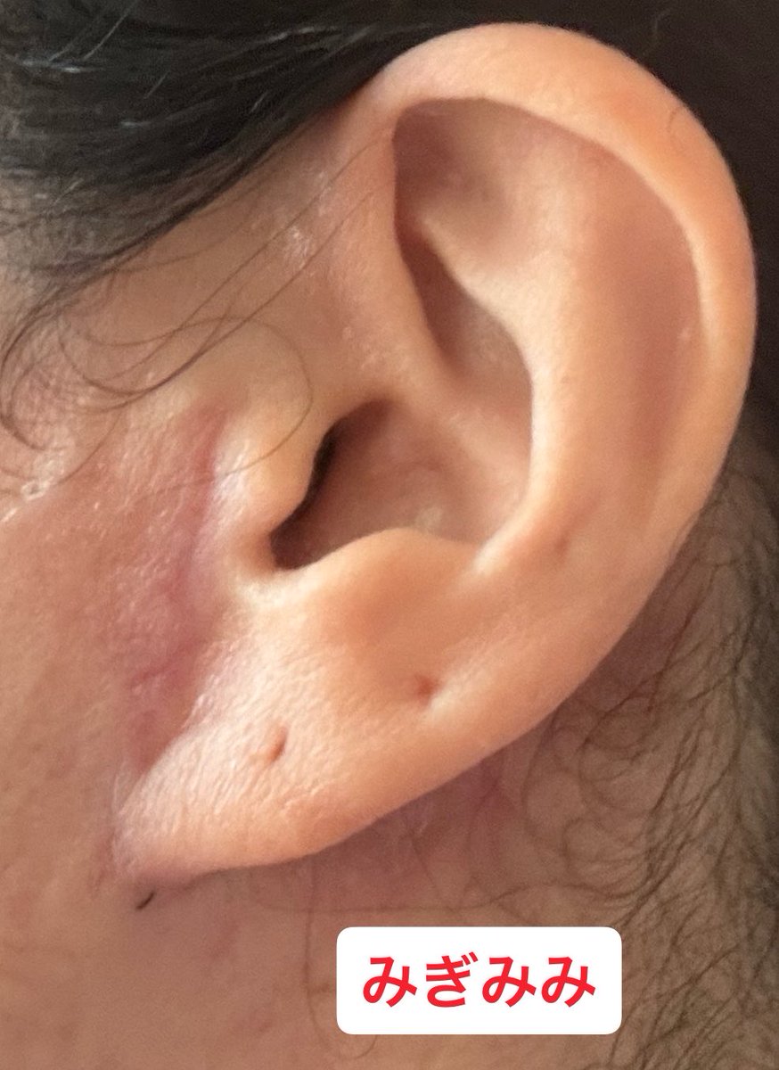 セサミ@切開フェイスリフトDT中（マンジャロ12.2〜） tweet media