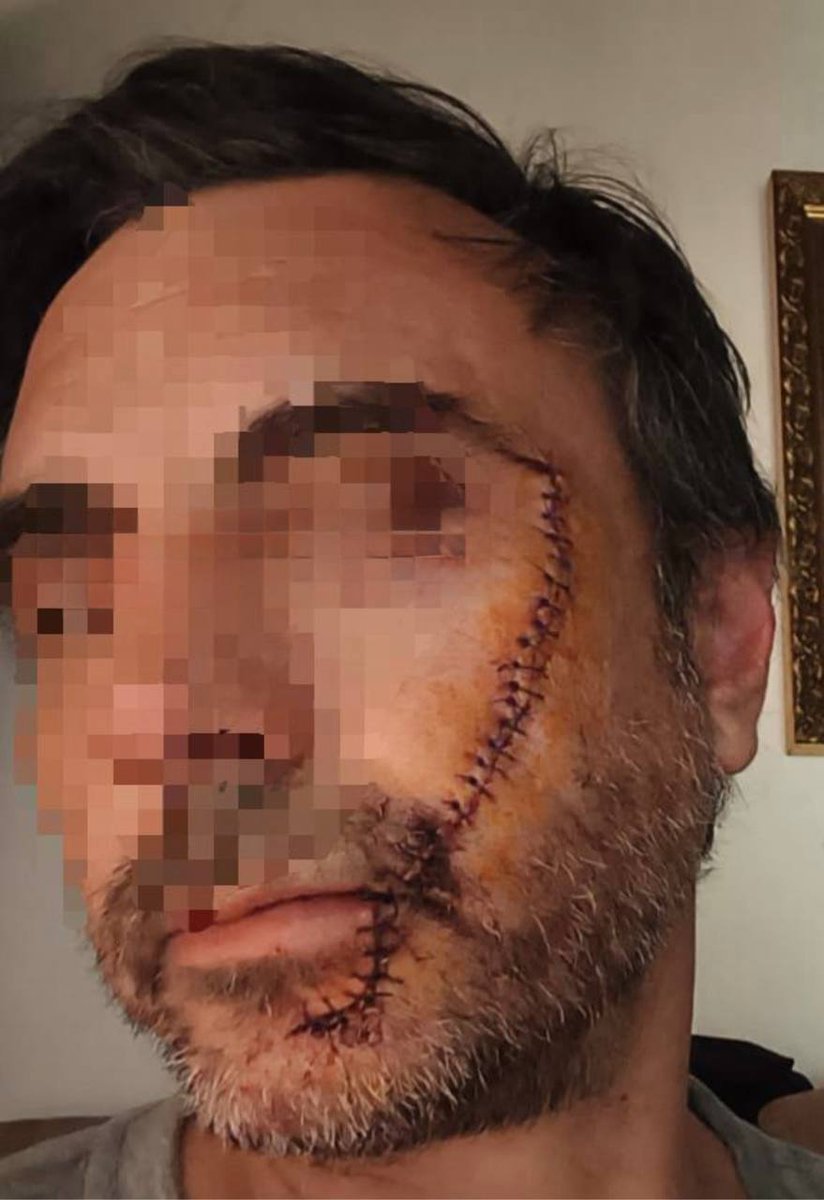 🇪🇦 ESPAÑA.

🔴🗞 Un marroquí fugitivo raja la cara a un hombre en Málaga, necesitando 32 puntos de sutura. Le atacó de improviso y sin mediar palabra por el simple hecho de pedirle que dejara de vandalizar coches:

💭 «Lo único que he hecho ha sido defenderme, casi me mata».
