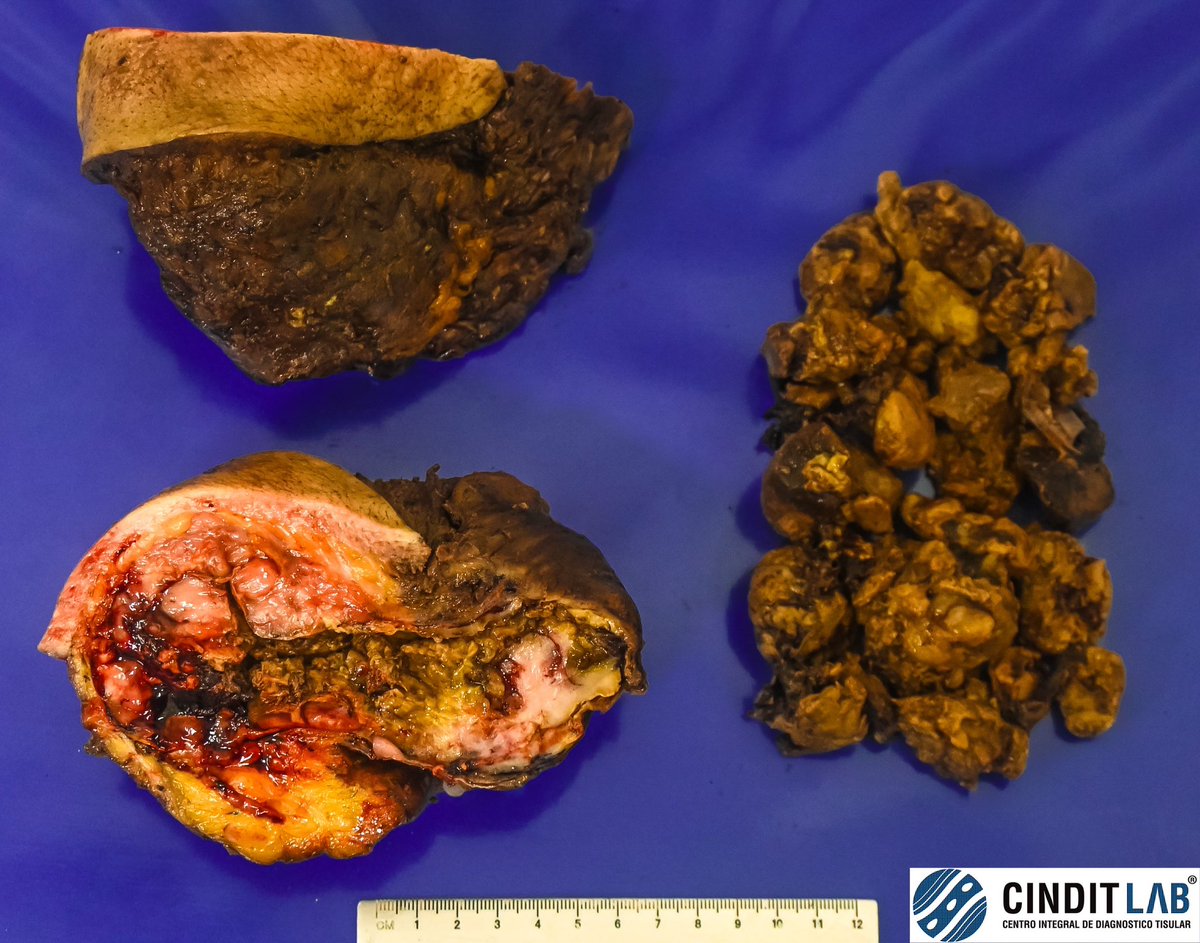 md_castaneda23's tweet image. Liposarcoma Pleomorfo de alto grado 

#pathologylab #cinditlab