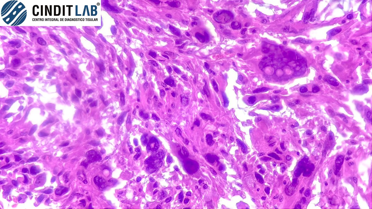md_castaneda23's tweet image. Liposarcoma Pleomorfo de alto grado 

#pathologylab #cinditlab