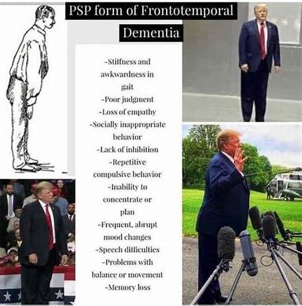 peterproctor's tweet photo. @allenanalysis Trump exhibits the pathognomic (points to the disease) symptoms of Frontal-temporal  dementia.  E.g., the classic foreward lean. https://t.co/V7HcCy2MpJ