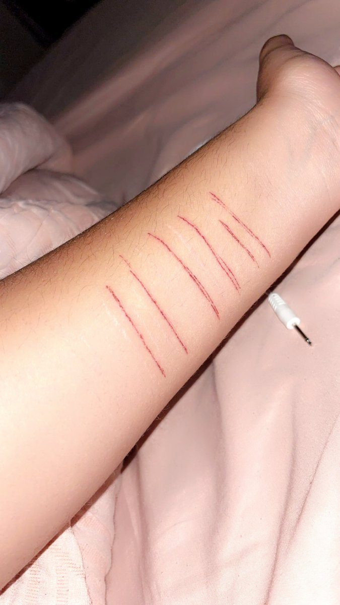 idkalnt's tweet image. *sh tw*
cat scratch relapse from 2 nights ago, scabbing overall good
#shtwt #sh