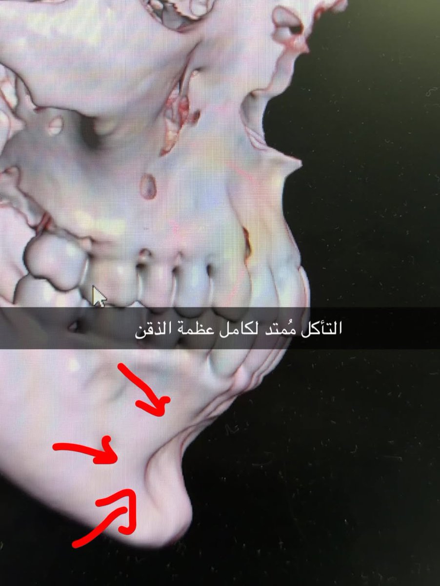 IBatool87's tweet photo. عبر دكتور ياسر العلي 
تتذكرون لما حذرتكم منه 

🔴🔴🔴🔴

حالة ذوبان في عظمة الذقن نتيجة لحقن الفيلر المُتكرر

الحالة لمُراجعة صغيرة بالسن تسبب حقن الفيلر المُتكرر بالذقن إلى ذوبان في عظمة الذقن بدون مُلاحظة اعراض واضحة حيث ان الحقن المُتكرر بالذقن بكل مره كان بكمية اعلى ولم يتضح تأثير ذوبان عظم الذقن على المظهر الخارجي.

مع الاسف ان اغلب الحالات تكون بدون اعراض واضحة ويتم اكتشافها خلال الفحص الروتيني. 

غالباً التدخل الجراحي بيكون مطلوب لتصحيح الذقن بعد إزالة الفيلر لعلاج ترهل الذقن