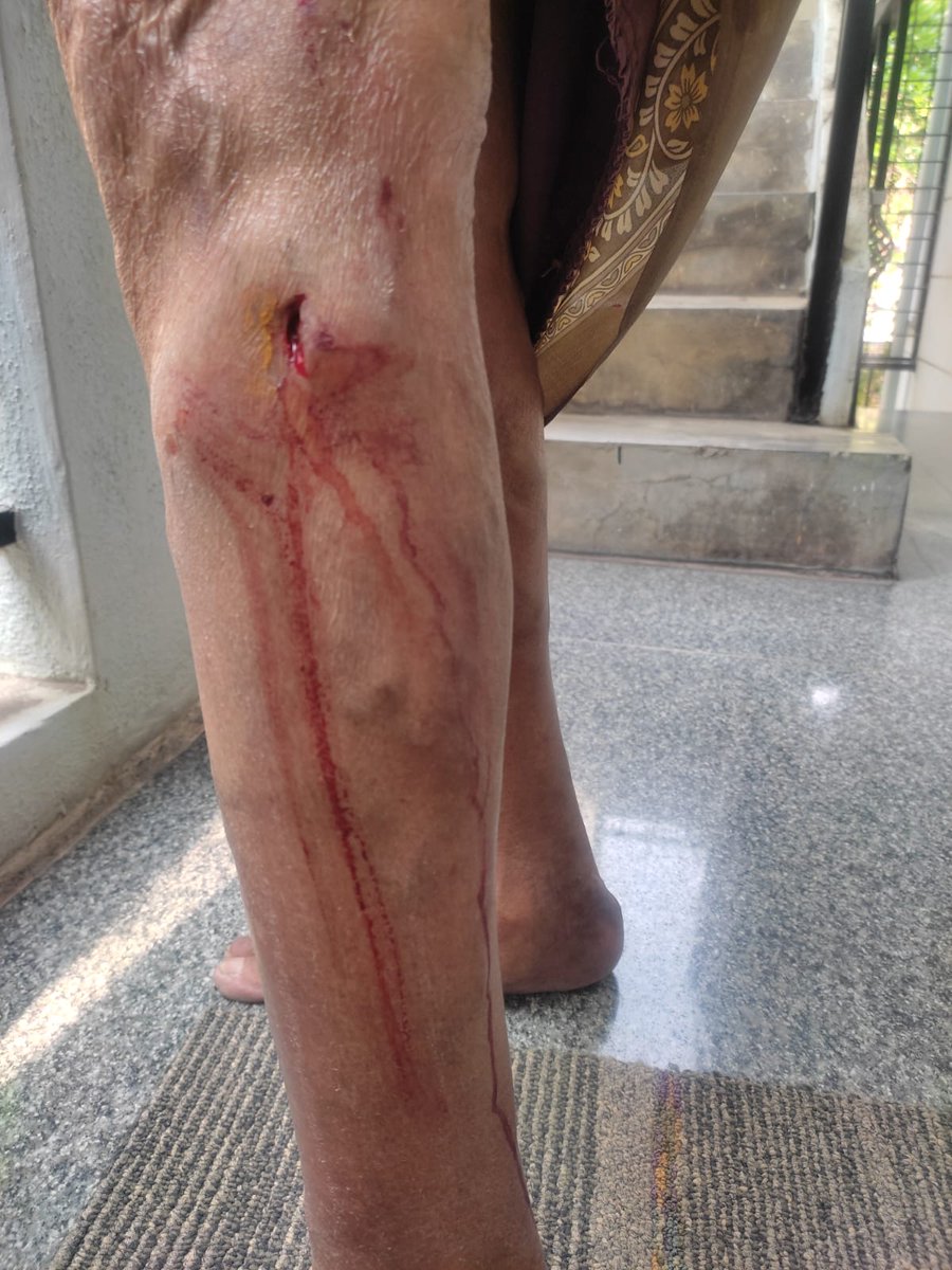 archersantha's tweet photo. @GBAChiefComm @comm_blr_south Repeated dog bite complaints remain unaddressed. Tickets: 21055154, 21078592, 21078246. This is a serious public safety issue, especially for children &amp; elderly. Please take urgent action. Sharing photos for reference. https://t.co/kTQ6QjLA6u