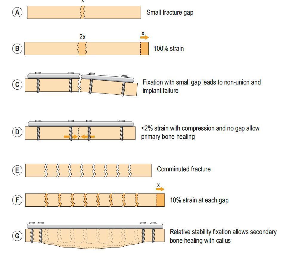 MoAImam's tweet image. Fracture Gaps: The Application of Perren’s Strain Theory.