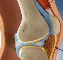 KRKISHOREKUMAR3's tweet image. Arthrofibrosis is unpleasant if not treated.
dearkish.blogspot.com/2026/04/arthro…
After surgery or trauma, excessive scar tissue production causes arthrofibrosis, a dangerous joint.  The condition may end permanently if untreated.
#Fibrous #scar #tissue #restricts #movement