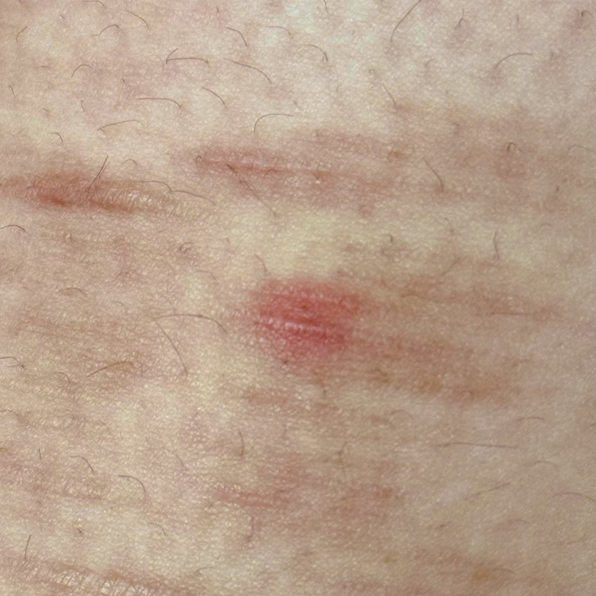 miraclemargz's tweet photo. weird bump on my scars (months old, forgot how long ago) is this something to be concerned about??? https://t.co/YZul6A7W0G
