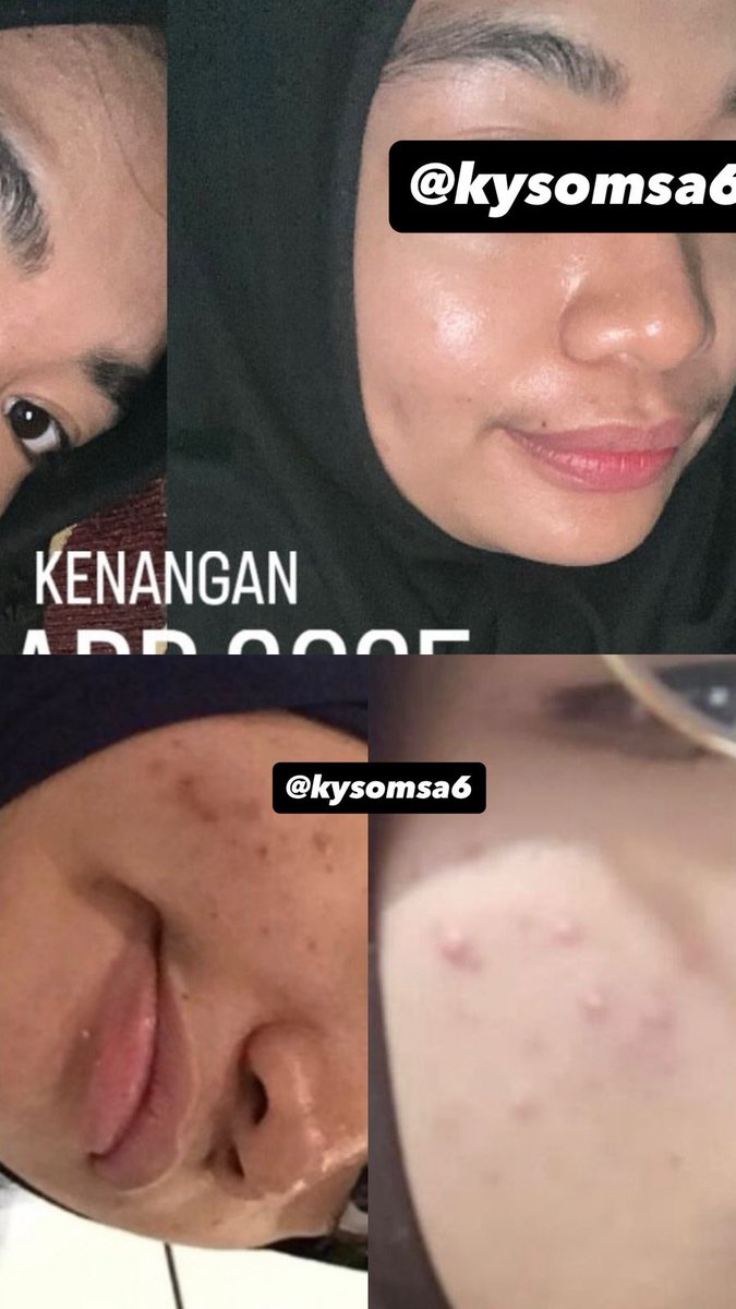 kysomsa6's tweet photo. Cara aku dapetin kulit bersih, setelah bertahun-tahun jerawat on off😍
#skincare #skincare #rekomendaskincare https://t.co/YwxKL0P1Ev