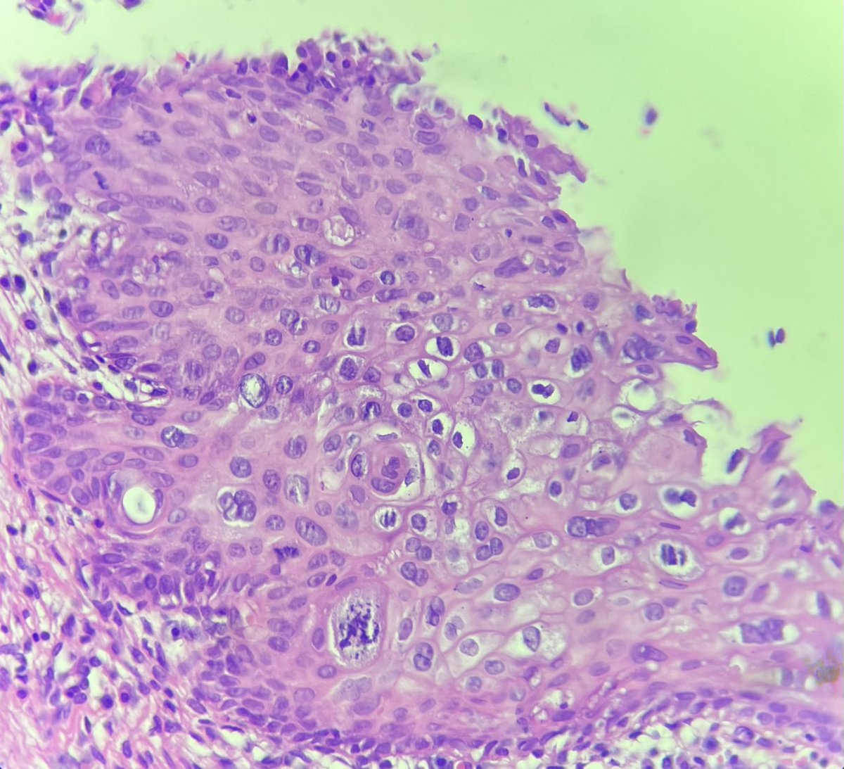 senaadsizdayanc's tweet image. 33Y cervical biopsy, HPV 18 (+)
HSIL/ CIN II 
#gynpath
#hpv
#pathology