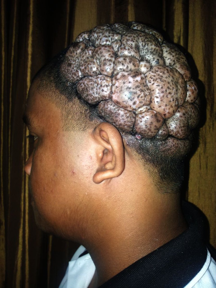 hemo_shk's tweet image. An 18-year-old Filipino male with an unusual presentation.

Likely diagnosis?