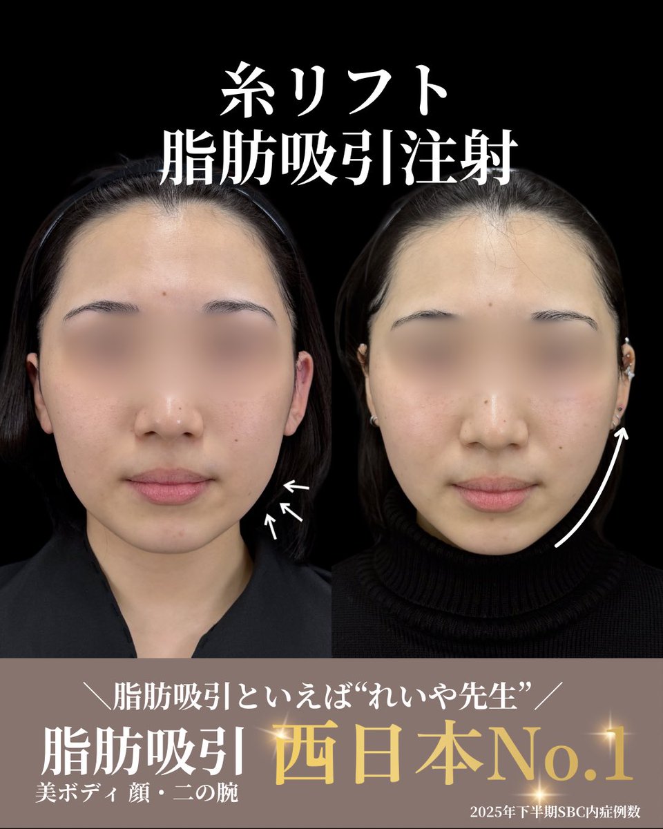 dr_reiya's tweet photo. ◎脂肪吸引注射（ホホ・アゴ下・ジョール）、糸リフト
術前⇒術後3ヶ月の経過

顔周りのボリューム感がスッキリして、フェイスラインがシャープになりました！

脂肪吸引注射は脂肪吸引より細い注射器を使用して、皮下脂肪を吸い出すため、ダウンタイムは短く、あざ・腫れを軽減できます。
また、脂肪吸引のような圧迫固定の必要はなく、創部パッチで保護をし、当日からメイクも可能です👌

脂肪吸引・脂肪吸引注射どちらもたくさんの指名予約をいただいています！

🏆脂肪吸引(美ボディ/全部位総合)症例数西日本1位 全国2位 2025年下期SBC内

神戸三宮で全国有数の症例数、技術力
脂肪吸引は、れいや先生にお任せください👨‍⚕️

ご予約はプロフィールのリンクから👈
皆様のご来院お待ちしております✨

✴︎2025年下半期SBC内 症例数✴︎
◉脂肪吸引（美ボディ/全部位総合）
 西日本1位🥇 全国2位🥈
◉脂肪吸引注射 関西2位🥈
◉脂肪注入(ナチュラル脂肪注射) 関西2位🥈
◉糸リフト 関西3位🥉
◉バッカルファット除去 関西3位🥉
………………………………………………
🏥イテウォンビューティークリニック神戸院
📍 兵庫県神戸市中央区御幸通6-1-10
オリックス神戸三宮ビル 5階
🏃‍♂️JR三ノ宮駅徒歩5分
⏰ 9:00〜18:00▶︎不定休
☎️0120-832-900
………………………………………………

施術名：小顔用脂肪吸引注射
施術の説明：切開なしで脂肪を直接抽出できるので、脂肪溶解注射より確実に、脂肪吸引よりダウンタイムを少なく、狙った部分の脂肪を減らすことができる安全・確実・簡単な部分やせ術です。
施術の副作用（リスク）：だるさ・熱感・頭痛・蕁麻疹・痒み・むくみ・発熱・咳・冷や汗・胸痛・吸引部の皮膚が硬くなる、凹凸になる・効果に満足できない・施術箇所の知覚の麻痺・鈍さ、しびれ・皮膚の色素沈着などを生じることがあります。
施術の価格：50,000円～135,000円

施術名：若返り
施術の説明：若返り治療には、レーザーや糸でたるみを解消するリフトアップ治療、注射で薬剤を注入してしわを軽減するしわ取り治療などがあります。
施術の副作用（リスク）：内出血、発赤、熱感、痒み、痛み、だるさ、乾燥、発熱、施術箇所の違和感、異物感、鈍さ、しびれ、ひきつれ、凹凸、色素沈着などを生じることがあります。
施術の価格：3,500円～992,240円

#湘南美容クリニック 
#小顔 
#脂肪吸引 
#脂肪吸引注射