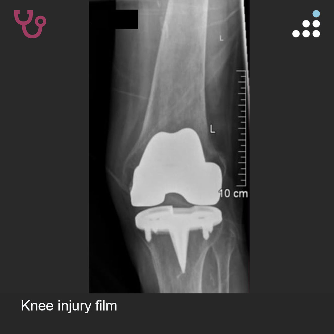 orthobullets's tweet image. Here is a new case by Dr. Anas Malkawi @somatostatin57 and Kreiskrankenhaus Mechernich GmbH.

SUBTROCHANTERIC FEMUR FRACTURE WITH SEVERE HIP OSTEOARTHRITIS IN 84F

How would you manage this #orthotwitter?

Vote on this case for CME: orthobullets.tiny.us/2p97nf7m