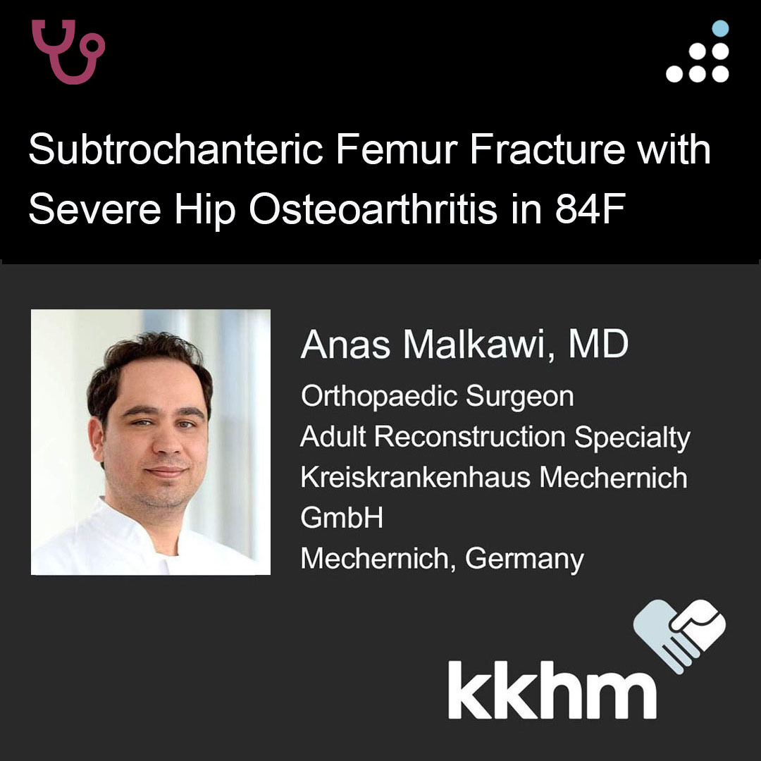 orthobullets's tweet image. Here is a new case by Dr. Anas Malkawi @somatostatin57 and Kreiskrankenhaus Mechernich GmbH.

SUBTROCHANTERIC FEMUR FRACTURE WITH SEVERE HIP OSTEOARTHRITIS IN 84F

How would you manage this #orthotwitter?

Vote on this case for CME: orthobullets.tiny.us/2p97nf7m
