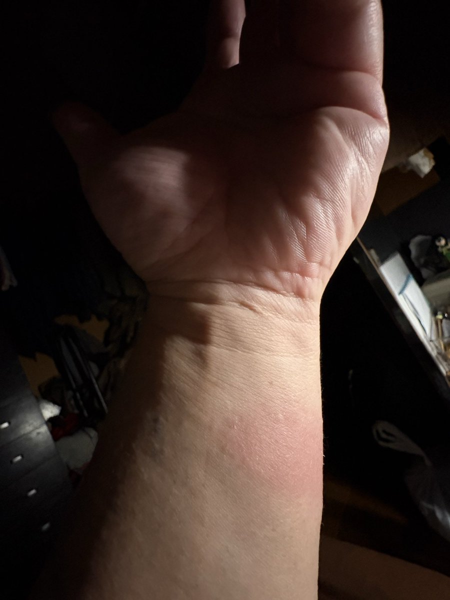 okejiroro's tweet photo. 先日のキャンプから帰ってから右腕が痛痒くて不自然に腫れてきてまあ虫刺されだろうとムヒ塗って放置してたら左腕の同じ位置も同じく腫れてきて。山の神か��に掴まれたのかと戦慄したけど多分焚き火ん時に低温火傷したんじゃないかと推測。丁度革手袋とジャケットの隙間。皮膚科不可避かねぇ… https://t.co/MODA8sPdsA