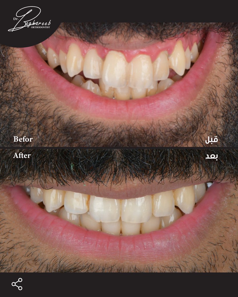 dr_baghareeb's tweet image. حالة مراجعي كانت تعاني من سوء إطباق من الدرجة الأولى وتزاحم في الأسنان العلوية والسفلية.
في حالات التزاحم، غالبًا نلاحظ:
تجمع الجير والتهابات اللثة
لكن مع التقويم الشفاف وإعادة الاصطفاف الطبيعي للأسنان، تم حل المشكلة 🙏

والنتيجة؟
ابتسامة أجمل وصحة أفضل ✨
#dental #invisalign