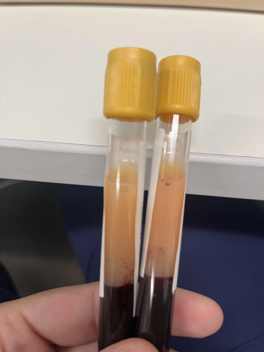 Cthullu_Call's tweet photo. @Doctors__squad Hyperlipidemia https://t.co/JF8VWP2yrv